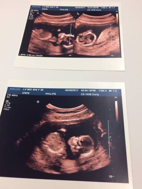 14周彩超医生说是个 男宝宝_第一胎刚2周岁是