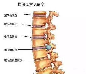 l5s1 椎间盘突出症,行血球切除术和椎间盘切除 脊柱常见疾病