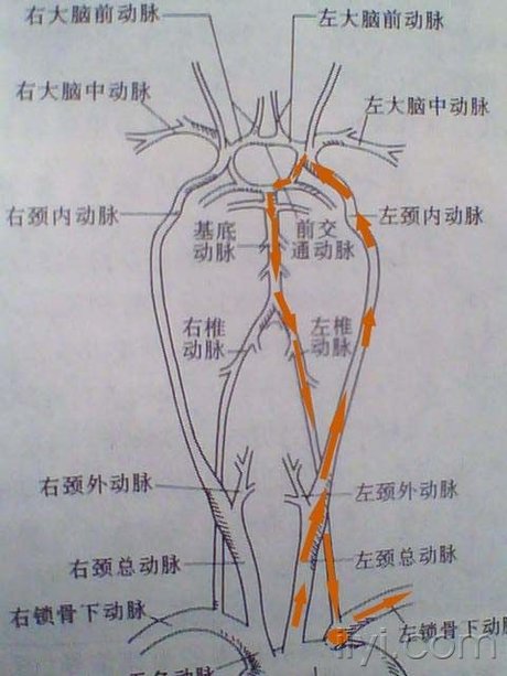 锁骨下动脉窃血 综合征