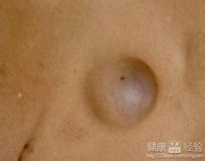 腋下 皮脂腺囊肿 斗图表情包大全   与 腋下 皮脂