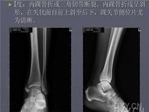 脚踝骨折没打石膏 斗图表情包大全   与  脚踝骨