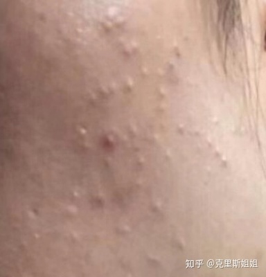 怎么才不长痘痘