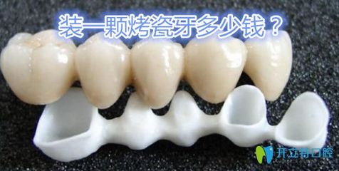 烤瓷牙冠多少钱