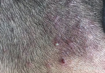 白脓的痘痘什么样