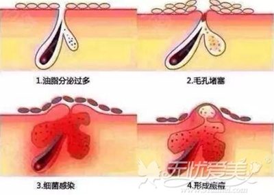 背后长痘痘可以激光吗