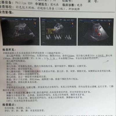 胎儿多少斤正常