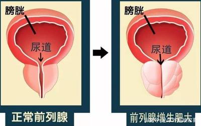 看前列腺肥大要多少钱