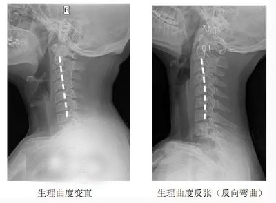 颈椎反张怎么治疗