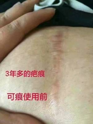 怎么确定是不是疤痕体质