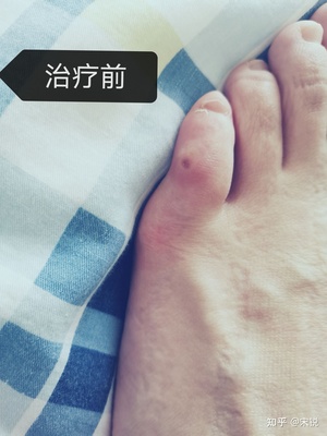 小脚外侧疼是怎么回事