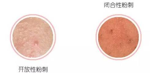 粉刺能用手挤吗