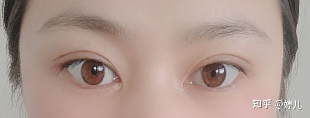 全切双眼皮恢复过程
