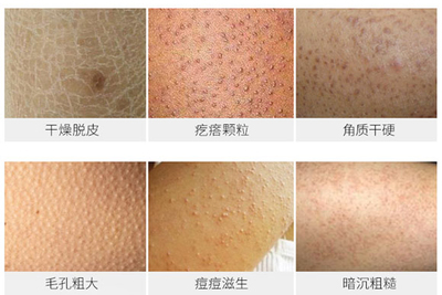 痘痘后脸颊毛孔粗大怎么办