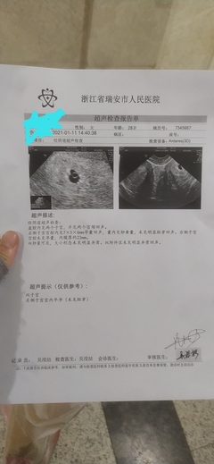 人民医院宫外孕多少钱