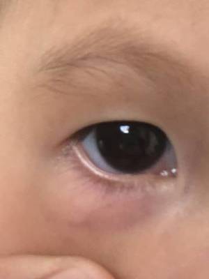 宝宝眼睛有红血丝是怎么回事