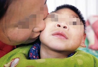 新生儿鼻腔狭窄