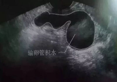 宫颈息肉会影响胎儿吗
