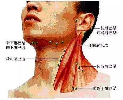 脖子两侧淋巴疼是怎么回事