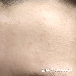 额头长闭口痘痘是什么原因