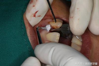 牙齿做牙周手术多少钱
