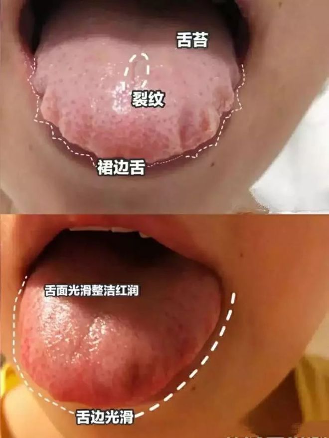 舌苔没了是怎么回事