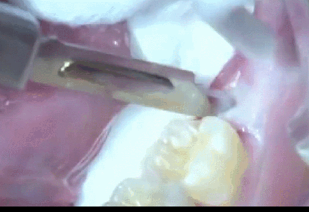 阻生牙齿能拔吗