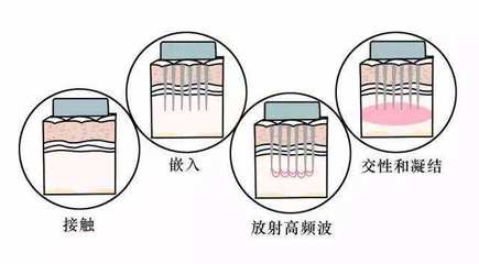 根除痘痘 痘印