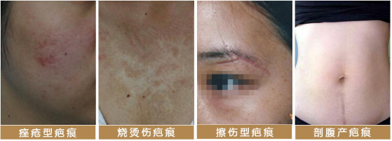 水痘疤痕修复