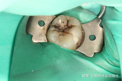 补牙的银汞容易去除吗