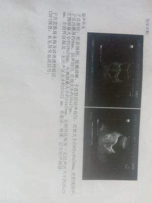 怀孕卵巢囊肿怎么办