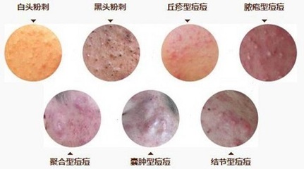 怎么去除囊肿型痘痘