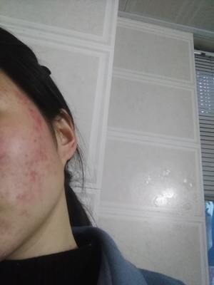 满脸都长痘痘怎么回事