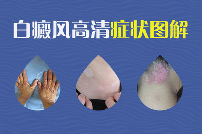 白癜风该怎么治疗好