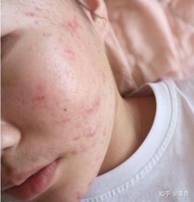 姨妈期起痘痘的原因