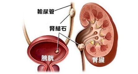 肾的两边疼是怎么回事