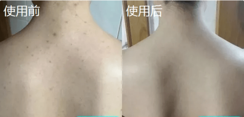 后背长痘痘擦什么