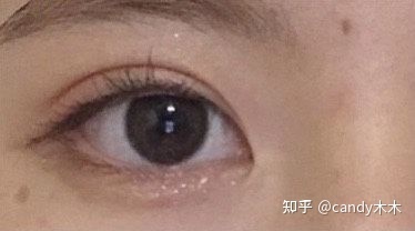 双眼皮疤痕多久才淡化