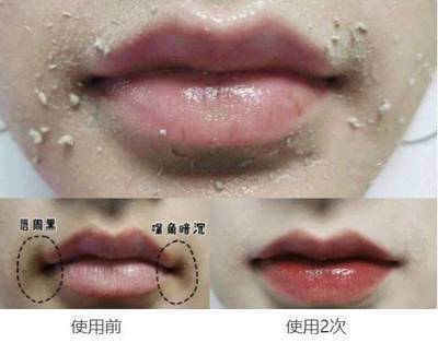 16岁毛孔粗大怎么办