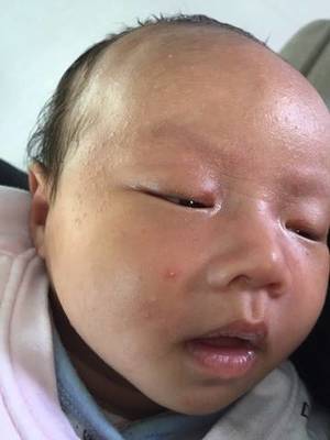 新生儿咖啡斑会消退吗