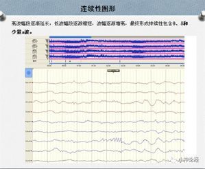 新生儿做脑电图有影响吗