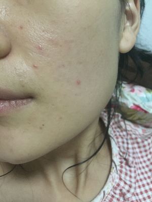 狮王化妆水痘痘变大了