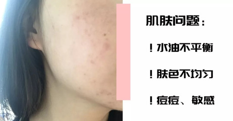 敏感肌肤 痘痘越来越多