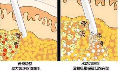 抽脂融脂