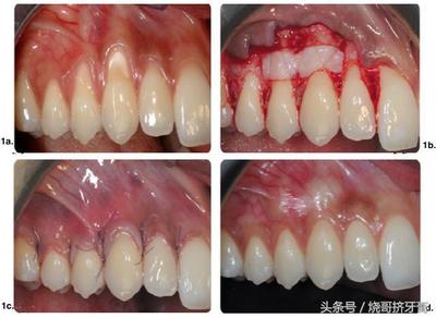 洗牙后牙龈萎缩