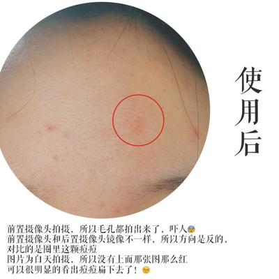 痘痘毛孔方向