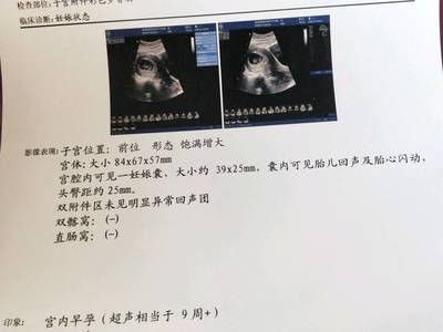 孕9周胎儿