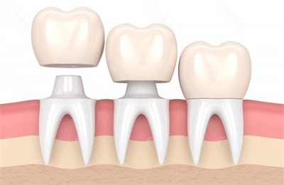 牙冠修复多少钱全瓷