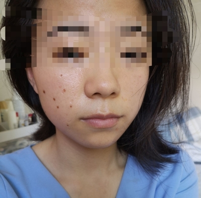 激光点肉痣