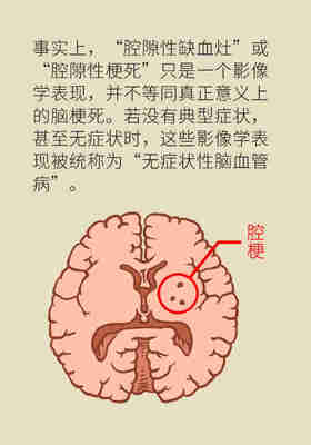 脑梗是怎么回事
