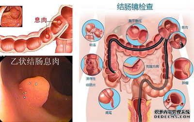 痔疮犯了怎么治疗最好